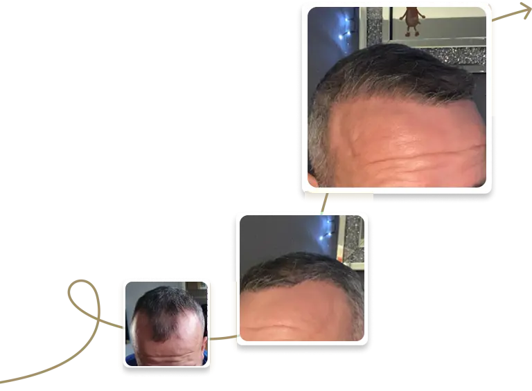 FUE patient testimonial